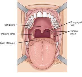 WHO updates Oropharynx SCC is now its own chapter separate from oral cavity SCC HPV+ oropharyngeal SCC is a