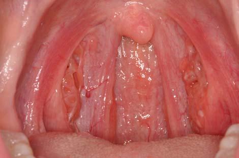 HPV+ oropharyngeal SCC (75% of oropharyngeal SCCs) Tonsils and base of tongue HPV 16 accounts for at least 90% of cases 3 5