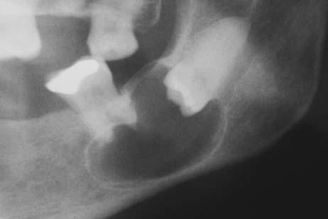 Dentigerous cyst Can cause displacement of the impacted tooth, root