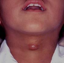 Thyroglossal Duct Cyst Appear as a painless midline mass Present at birth, may not become apparent until adulthood Excision