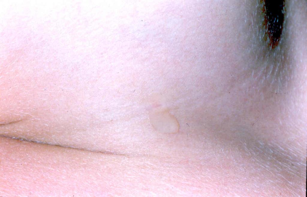 BRANCHIAL 'CLEFT' CYSTS 2nd Branchial Cleft Cyst- MOST COMMON - opens on neck ANTERIOR TO STERNOCLEIDO- MASTOID