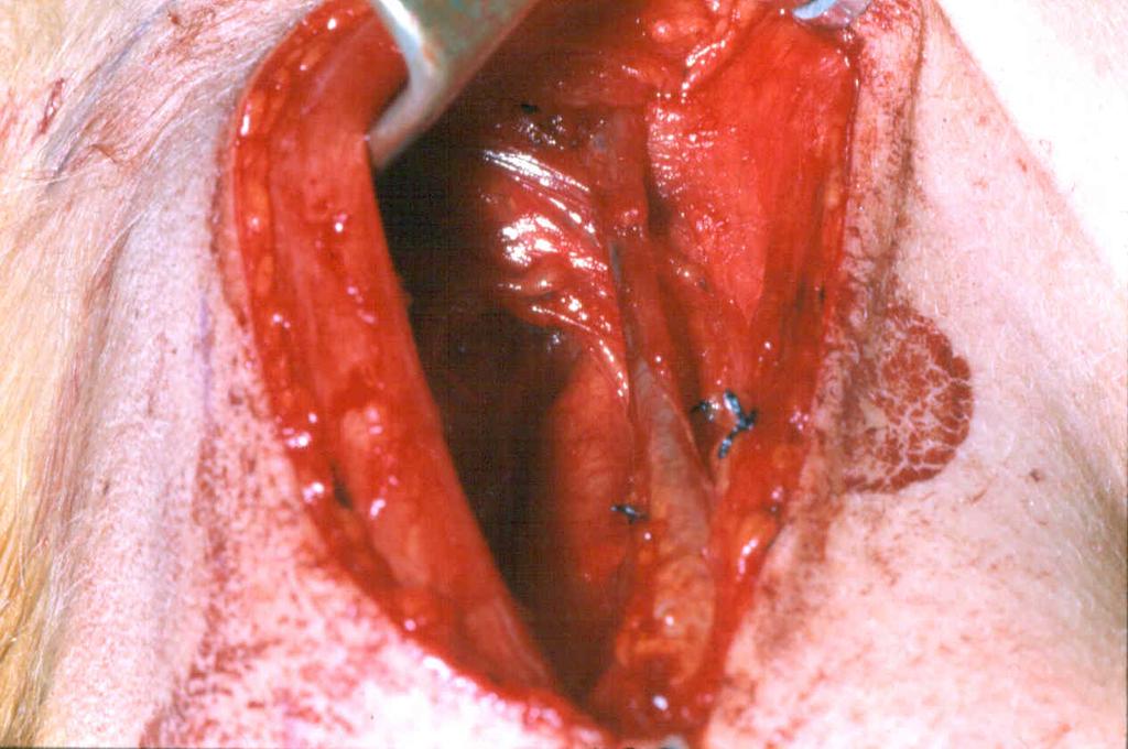 BRANCHIAL 'CLEFT' CYSTS 2nd Branchial Cleft Cyst- MOST COMMON - opens on neck ANTERIOR TO STERNOCLEIDO- MASTOID MUSCLE - TRACT TO PALATINE TONSIL