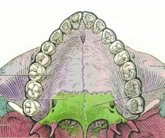 ANATOMY OF BONY PALATE INCISIVE FORAMEN - connects oral cavity and nasal cavity; contains Nasopalatine nerve (branch of V2),