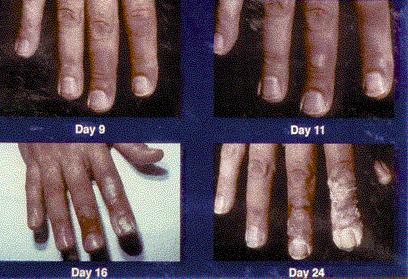 Cutaneous Radiation Syndrome (CRS) https://emergency.cdc.