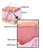 What causes atopic dermatitis Genetics Skin itself Immune system Assoc.