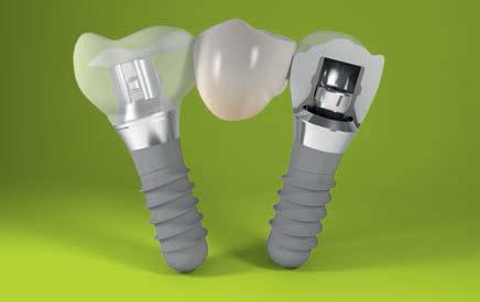 Thanks to the lower non-engaging conical shape, high angulations to the implant can be compensated.