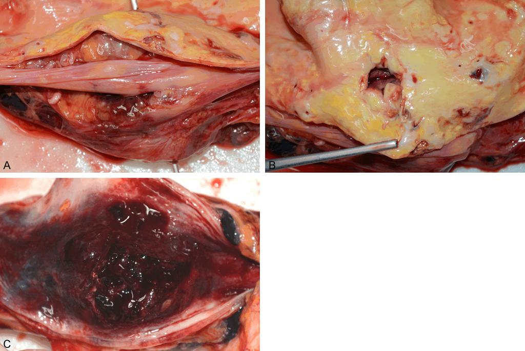 Figure 1. A. A ruptured aortoesophageal fistula is noted. B. An intimal lesion of around 1 cm in diameter and atherosclerotic calcification are noted. C.