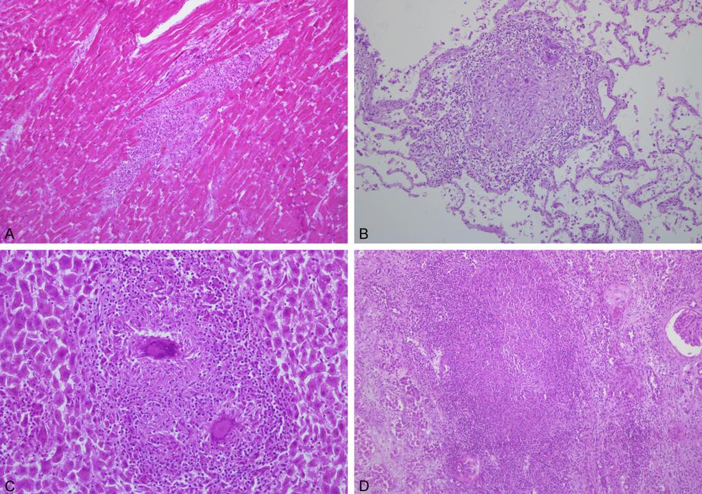 Figure 3. Multiple caseating epithelioid granulomatous inflammations within the giant cells were revealed in the various organs including the heart (A), lungs (B), liver (C), and kidney (D).