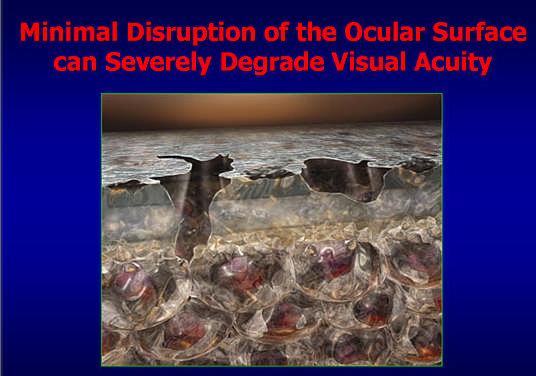 The Ocular Surface: Role in Vision Quality Vision quality