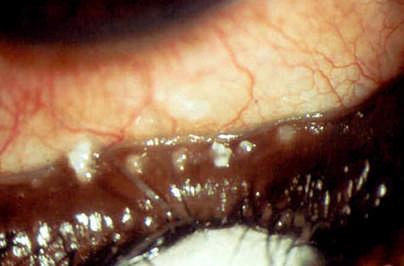 Pre-Op Evaluation MGD: Toothpaste Careful evaluation of pre-existing dry eye and blepharitis is mandatory High risk for endophthalmitis if blepharitis untreated Image Courtesy of Gary N.
