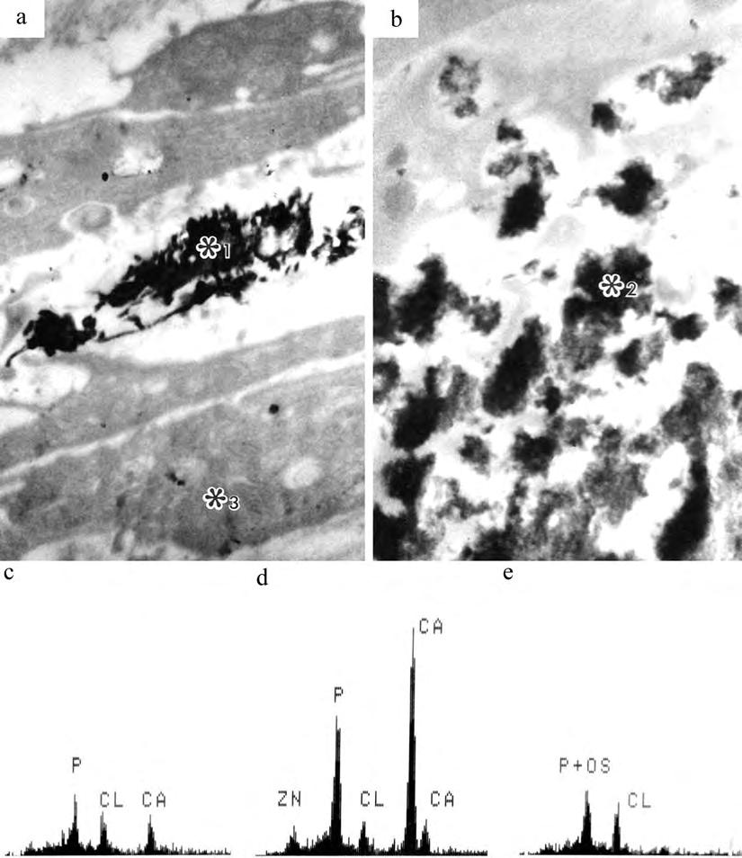 22 Chapter 2 Figure 10 STEM image of dystrophic calcification of attached collagen bundles (a), matrix vesicle calcification area (b), and analysis results of *1 in a (c), *2 in b (d), and *3 in a