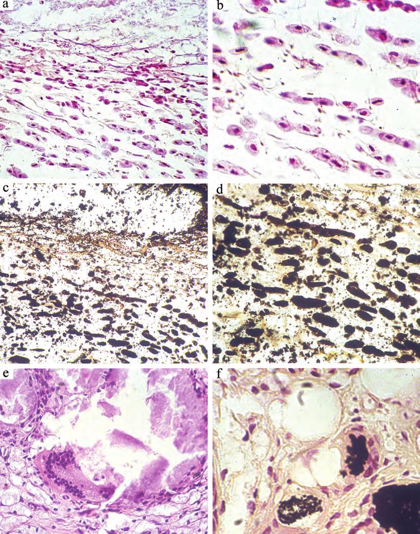 14 Chapter 2 Figure 2 1-week specimen shows proliferating granulation tissue around the embedded paste. Macrophage rich area (a), and enlarged photograph (b).