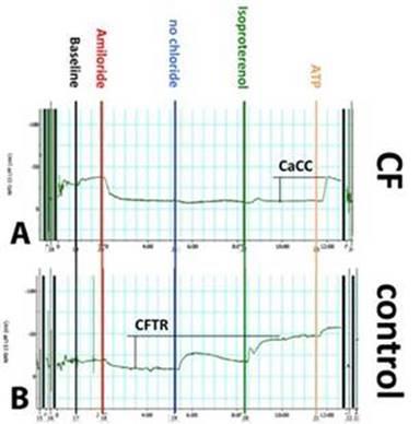 NPD is the only direct measurement of CFTR function NPD is only direct measurement of both sodium and chloride channel function CFTR downregulation of ENaC is well understood A response on