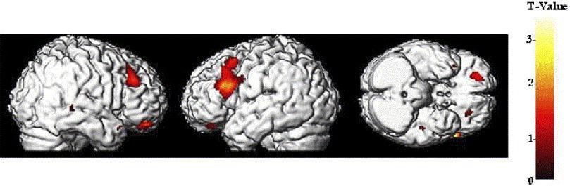 dementia 1 Associated with both cognitive 2 and functional impairment 3 Can be distinguished