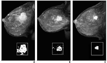 Magnetic Resonance Imaging: Staging and Response to Pre-surgical Therapy