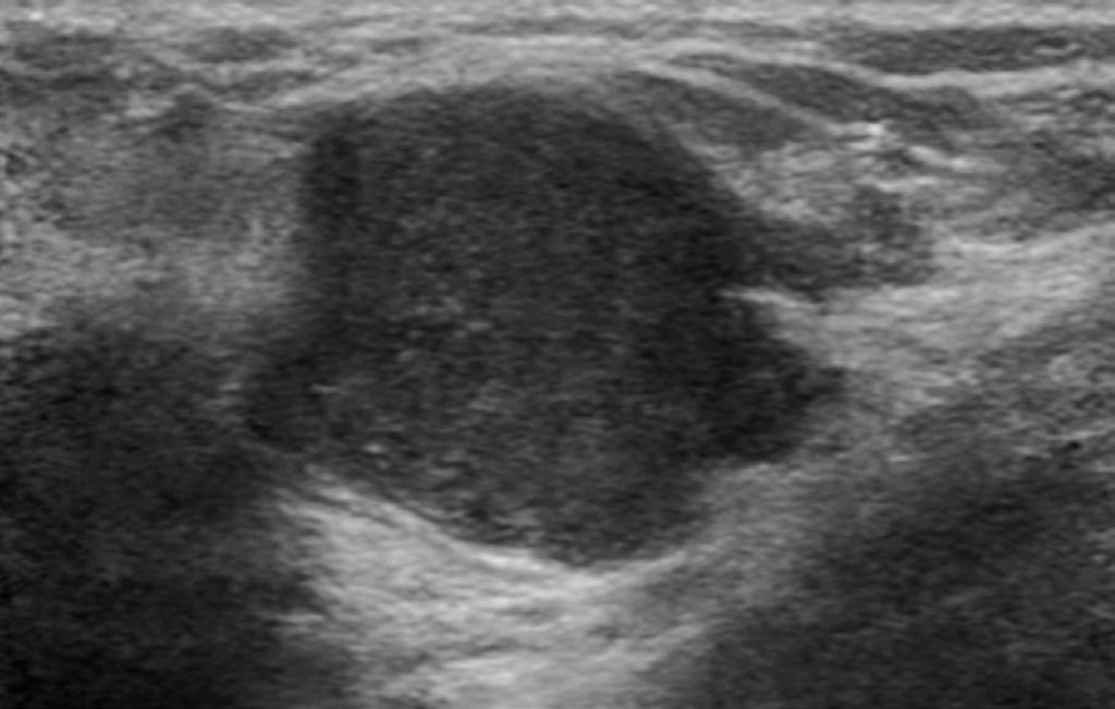 The result of ultrasound-guided core needle biopsy was fibrocystic change, which was considered to be discordant.