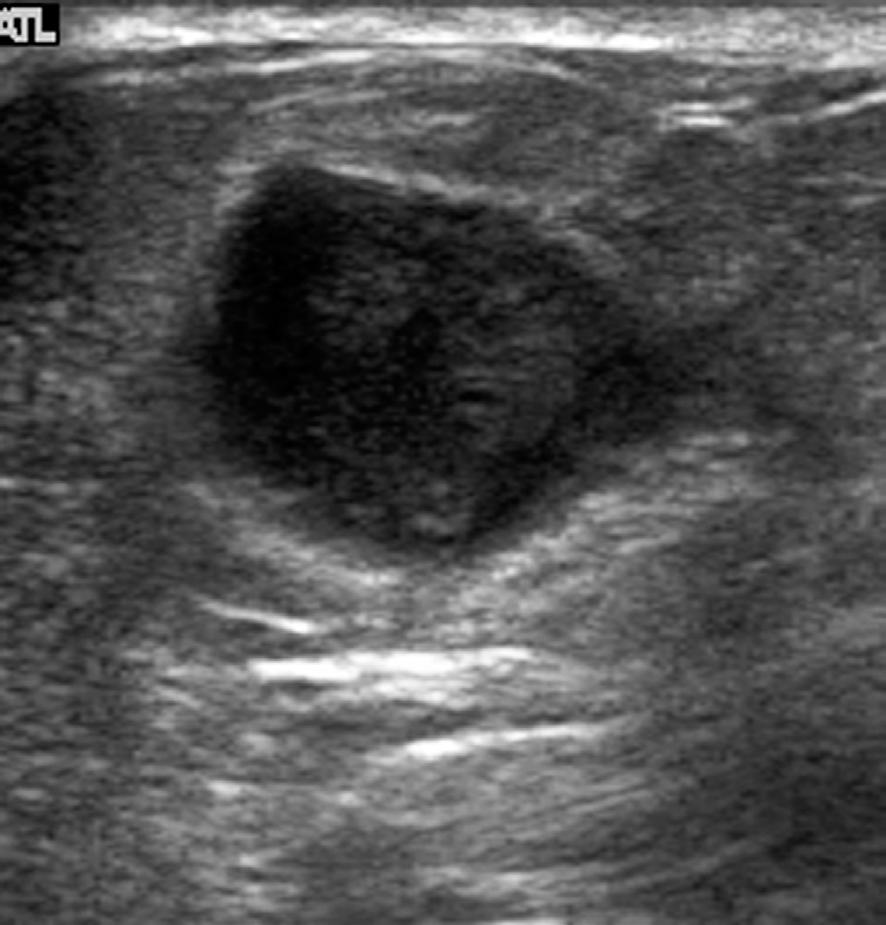 Ultrasonography shows a solid and cystic mass (arrows) (A) categorized as BI-RADS category 4a. The result of ultrasound-guided core needle biopsy was focal fibrosis.