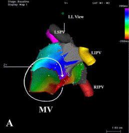 by PV triggers Effect of ablation?