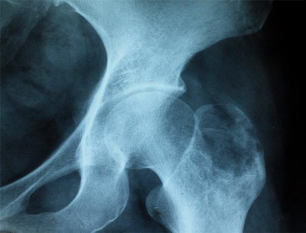 Figure 1. X-ray plain revealed a translucent expansive lesion with thinning, absorption and, partial discontinuity of cortical bone in the left greater trochanter.
