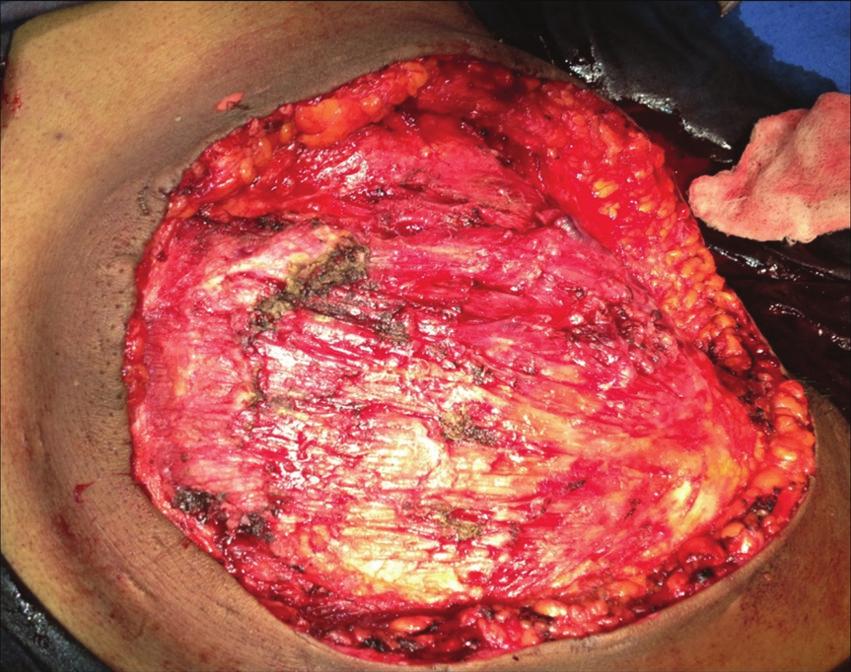 (Figure 8). All the resected margins were free of tumour.