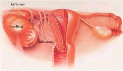 Pelvic Inflammatory Disease Adhesions-Tubal blockage STD Atlas, 1997 www.advancedfertility.com/hsg.