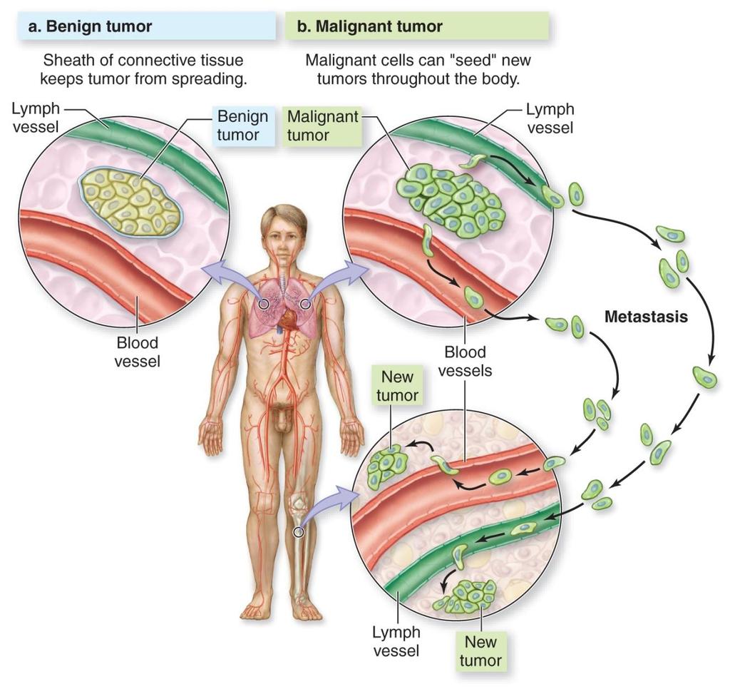 Cancer Arises When Cells Divide Out of Control A tumor is an abnormal mass of tissue.