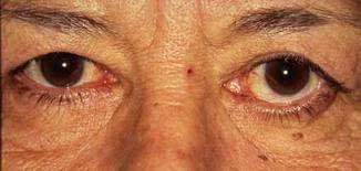 Lower Eyelid Retraction or Ectropion Surgery can worsen these