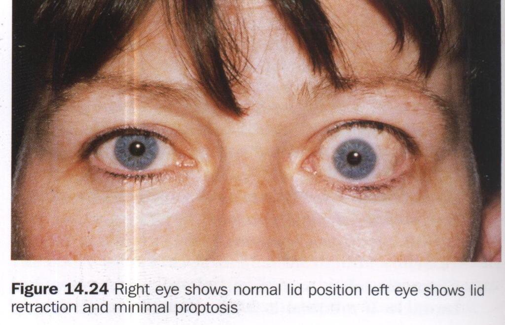 Clinical findings 1) Protosis with lid retraction ( corneal exposure) Ocular myopathy