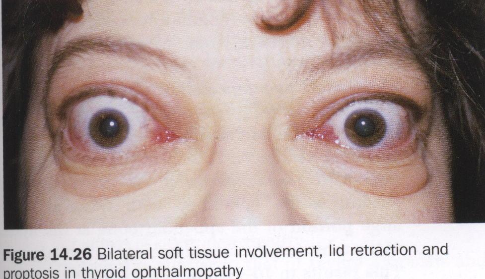 Treatment The goal of treatment of grave's ophthalmopathy is initially maintain corneal protection ( lubricant )