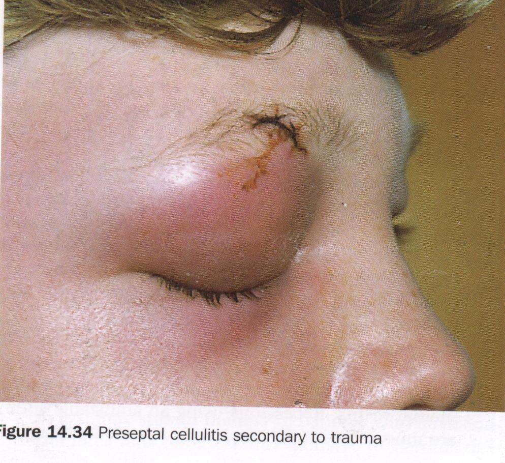 Clinical findings Orbital cellulitis : preseptal - postseptal