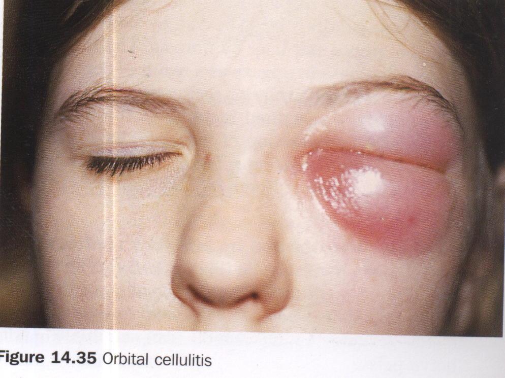 Postseptal orbital cellulitis Chemosis