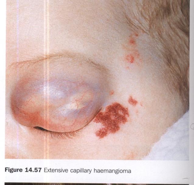 2) Cavernous hemangioma