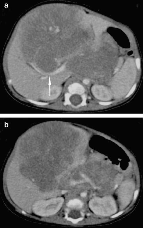 1098 Pediatr Radiol (2007) 37:1096 1100 Although it is uncommon in hepatoblastoma, about 10% of adults with hepatocellular carcinoma have diaphragmatic adhesion or invasion by tumour [7].