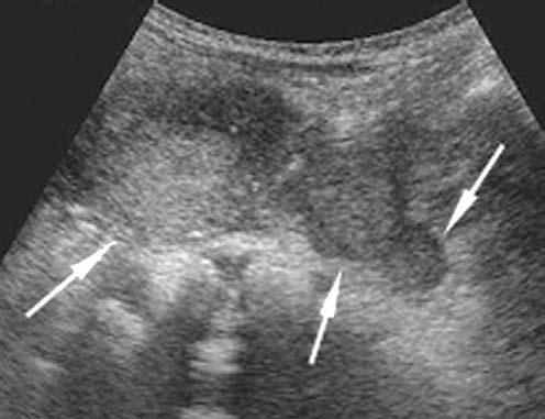 Diaphragmatic penetration by tumour may now be shown convincingly by MRI or CT (Fig. 1). Coronal or sagittal images may be more helpful than transverse images in this context.