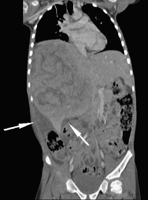 Pediatr Radiol (2007) 37:1096 1100 1099 Fig. 6 Tumour rupture in a patient with newly diagnosed hepatoblastoma (H1).