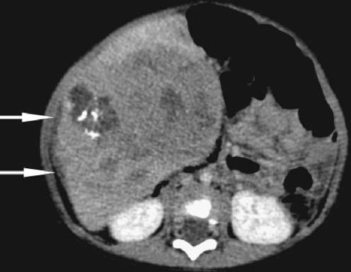 5 Peritoneal tumour nodules and ascites in a child with multifocal hepatoblastoma (E2a). a CT shows peritoneal nodules (arrows).