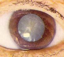 Cataract Clouding of the lens Usually age-related Causes glare