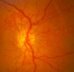 Diabetic retinopathy Two stages Non-proliferative Red and yellow