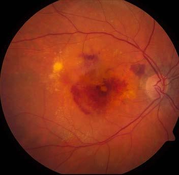 Macular Degeneration Two stages Dry Atrophic changes