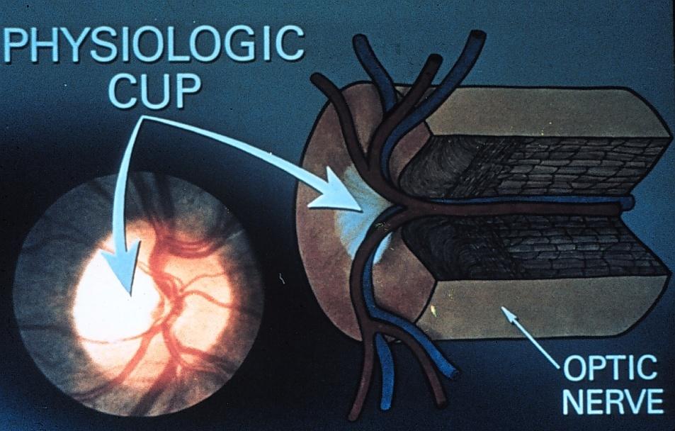 Cup-to-disk ratio The cup is the central portion of the nerve,