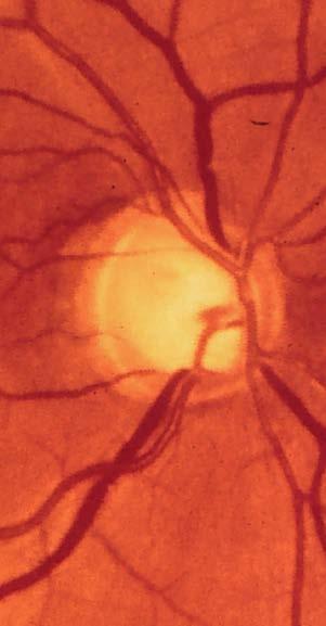 Red Reflex Vitreous Disk Vessels Background Macula Periphery