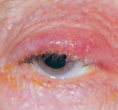 Blepharitis Inflammation of eyelids Presentation Red, thickened