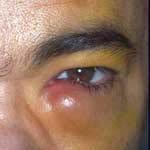 Dacryocystitis Inflammation of lacrimal