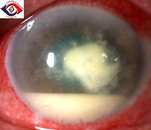 Bacterial keratitis Infection of