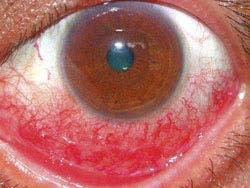 Allergic conjunctivitis Often seasonal April and September Itchy