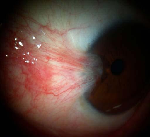 Extends onto cornea Vascularity creates chronic