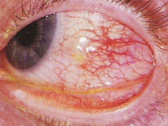 Episcleritis Focal inflammation of