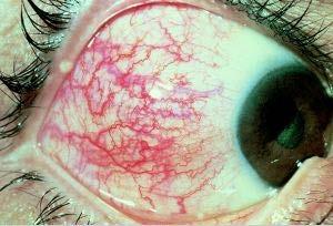 pain/redness Dilated vessels usually
