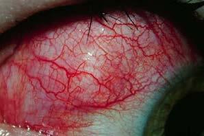 Scleritis Inflammation of sclera