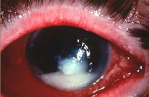 Endophthalmitis Infection inside eyeball Red,